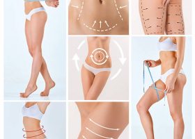 Collage of female body with the drawing arrows. Fat lose, liposuction and cellulite removal concept.
