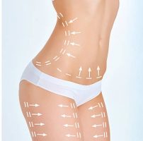 The cellulite removal plan. White markings on young woman body preparing for plastic surgery. Concept of slimming, liposuction, strand lifting